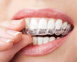 Benefits of Invisalign